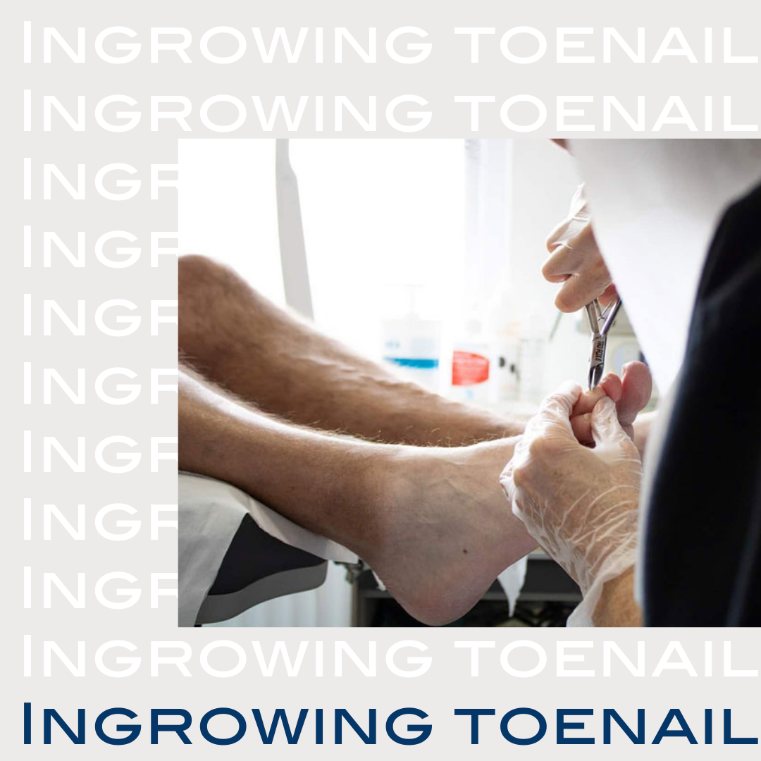 Now Is The Time For Ingrowing Toenail Surgery | The Nantwich Clinic | Health Care & Self Care | Nantwich | Cheshire